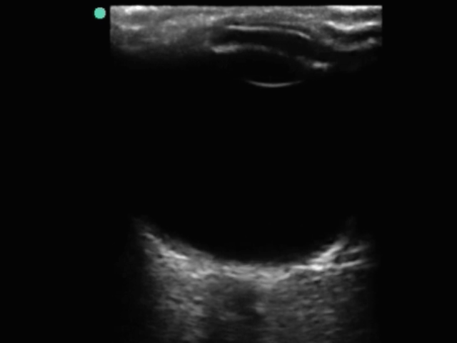 Ocular Retinal Nerve Sheath 1