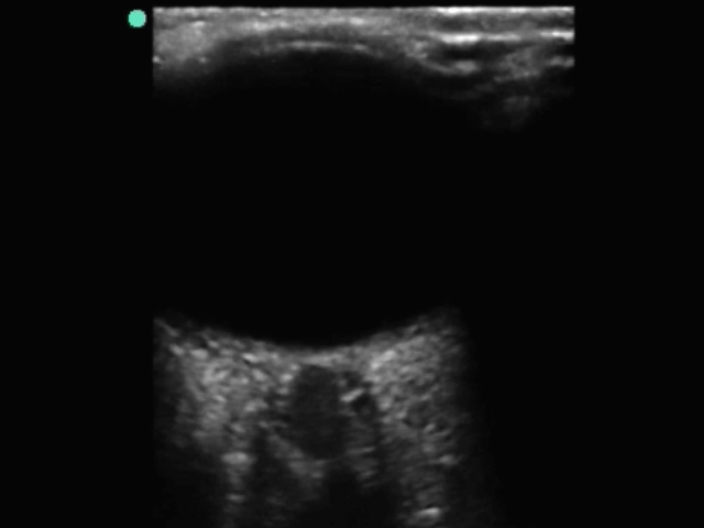Ocular Retinal Nerve Sheath 2