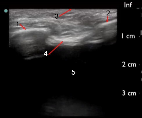 Linear Pleural Effusion Ultrasound