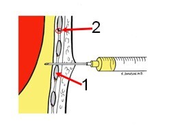Needle Position
