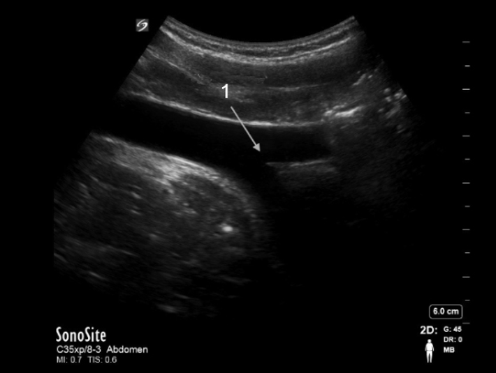 Aorta Bifurcation Sagittal