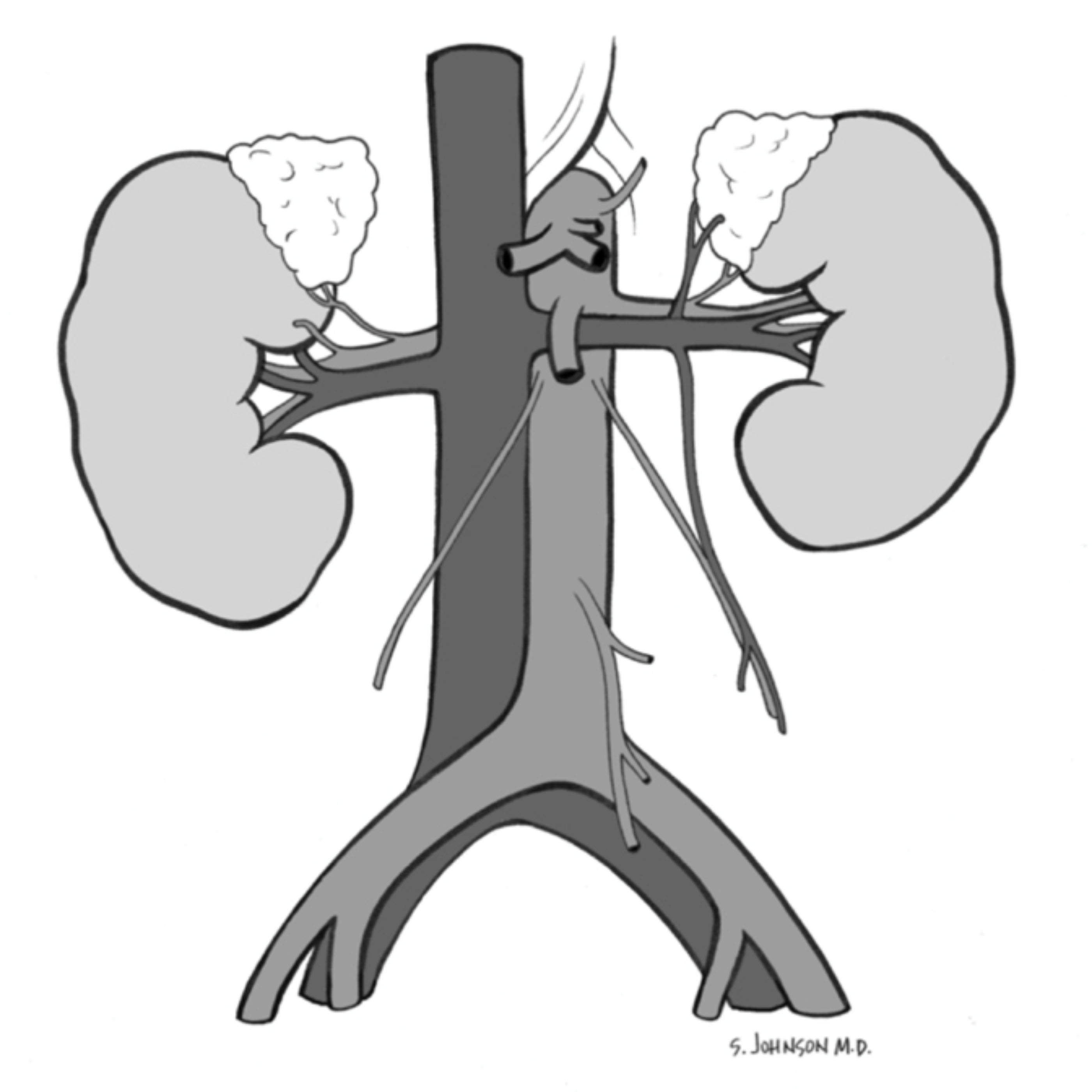 Aorta - diameter