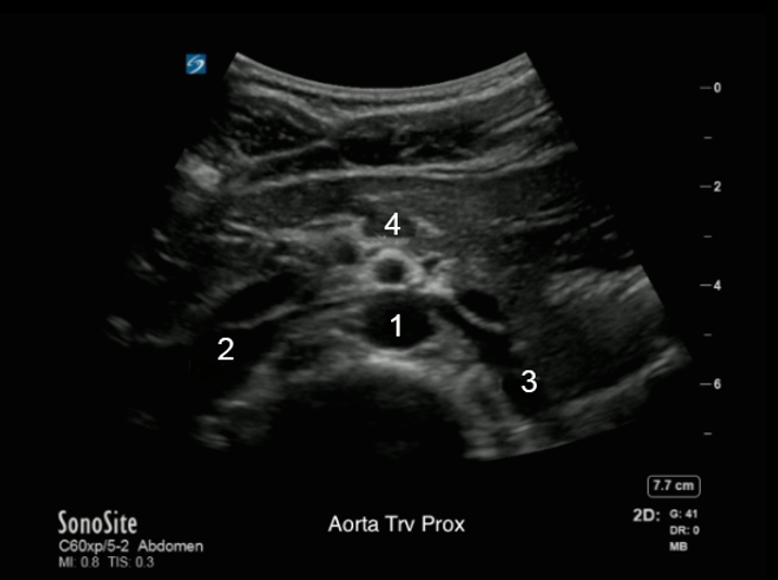 Aorta - Mid Transverse Image