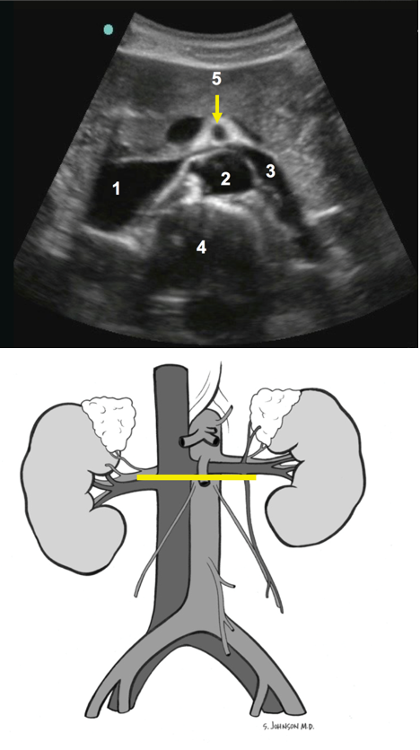 mid aorta