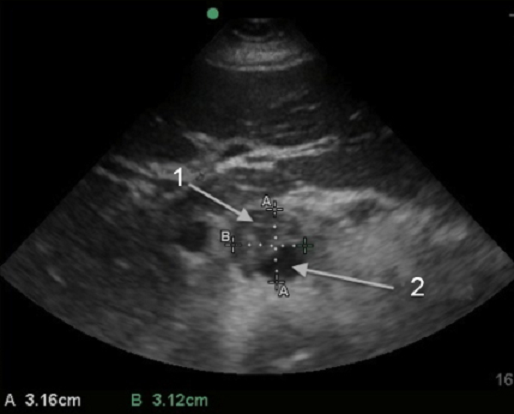 Aorta Small AAA with Thrombus Image